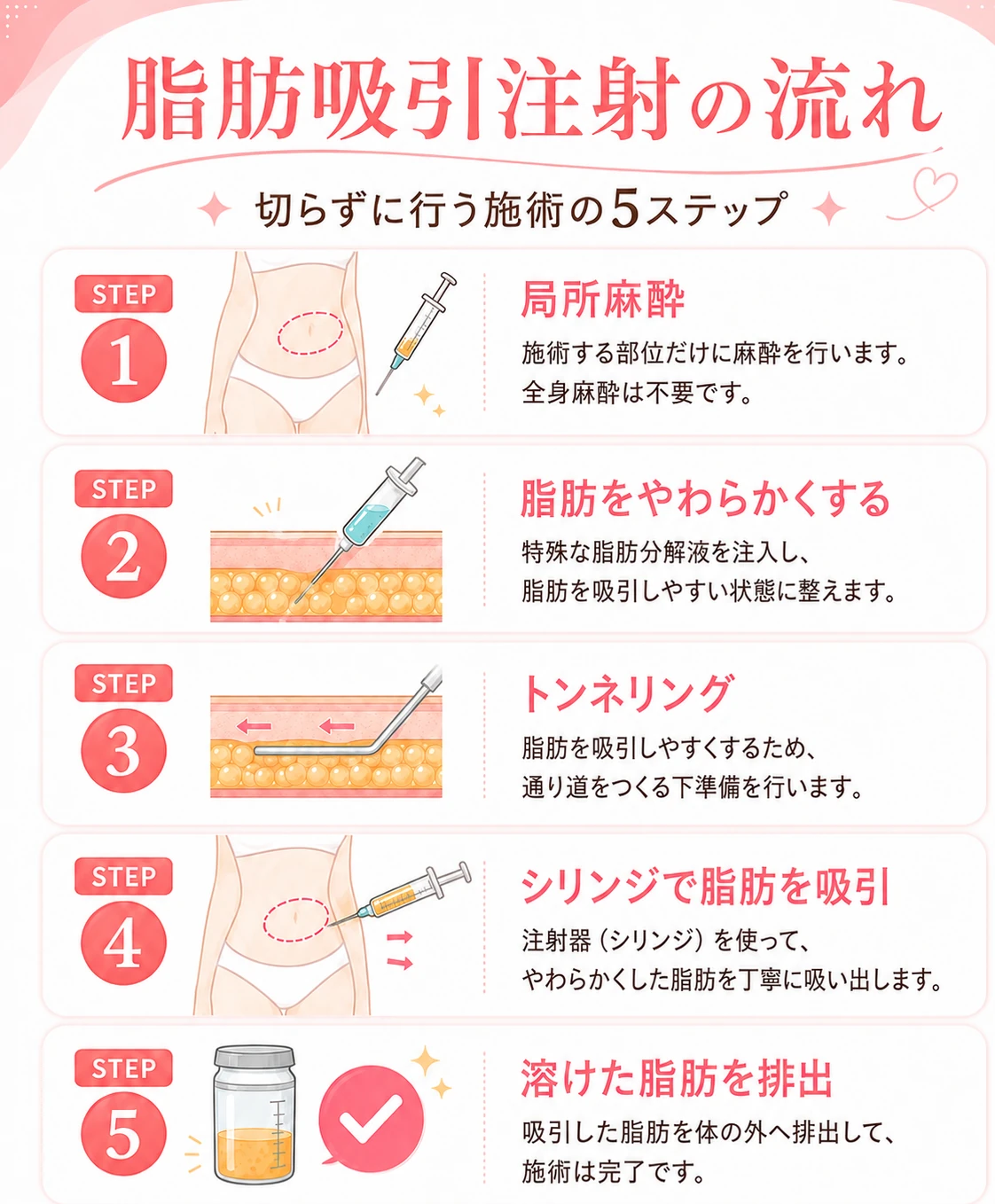 脂肪吸引注射（ラムス）の流れ・切らずに行う施術の5ステップ：STEP1 局所麻酔（施術する部位だけに麻酔・全身麻酔は不要）、STEP2 脂肪をやわらかくする（特殊な脂肪分解液を注入し脂肪を吸引しやすい状態に整える）、STEP3 トンネリング（脂肪を吸引しやすくするため通り道をつくる下準備）、STEP4 シリンジで脂肪を吸引（注射器でやわらかくした脂肪を吸い出す）、STEP5 溶けた脂肪を排出して施術完了