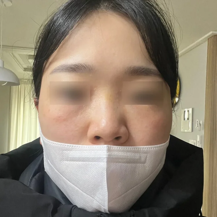 鼻整形・鼻先の症例（術前）